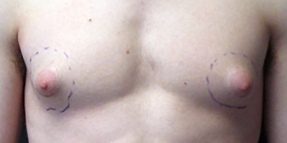 Causes and treatment of puffy nipples in men