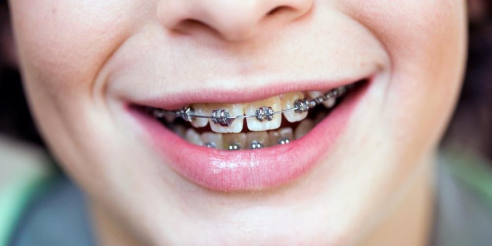 Do braces hurt? What to expect