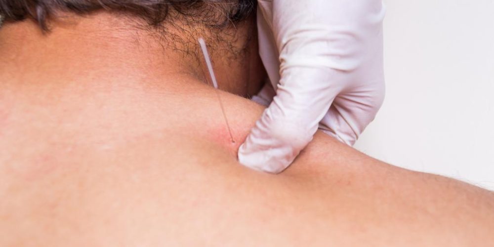 Dry needling vs. acupuncture: What the research says