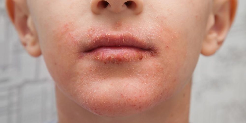 Dry skin around the mouth: Causes and remedies