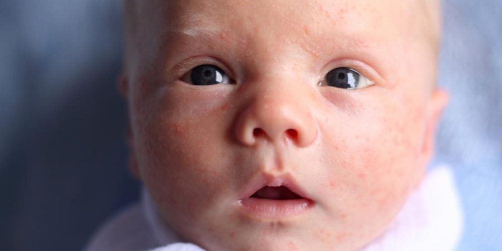 How to identify baby acne vs. a rash