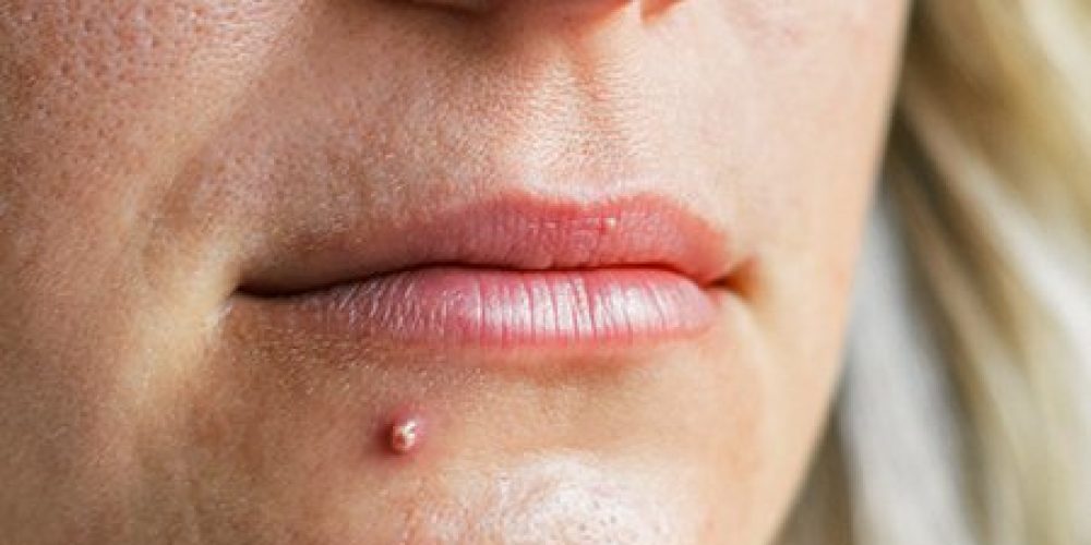 Pimple vs. Cold Sore