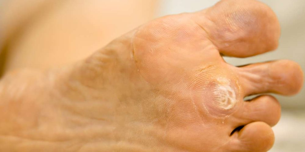 Plantar warts: Everything you need to know