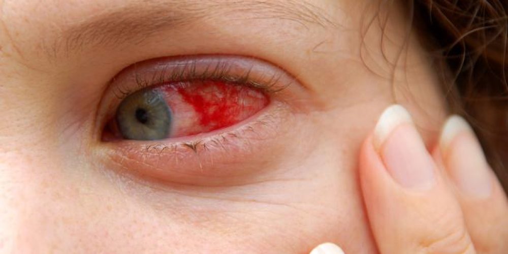 Red eyes: List of common causes