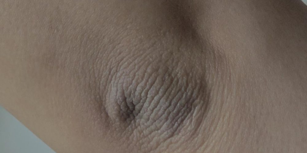 What to know about acanthosis nigricans