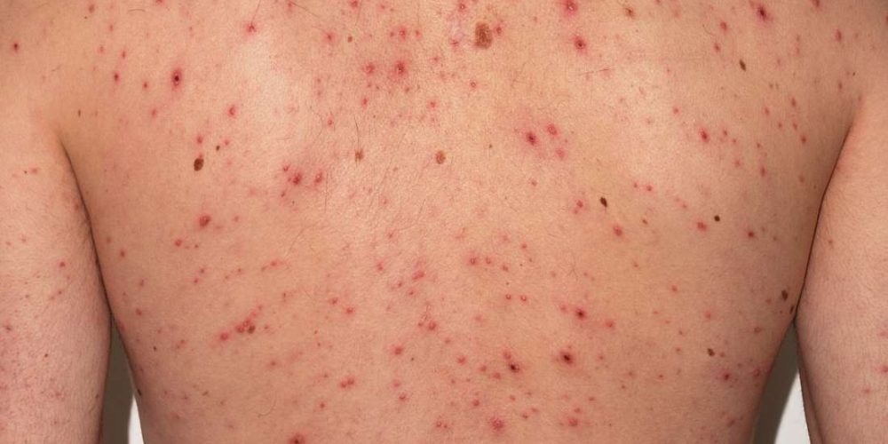 What to know about chickenpox in adults
