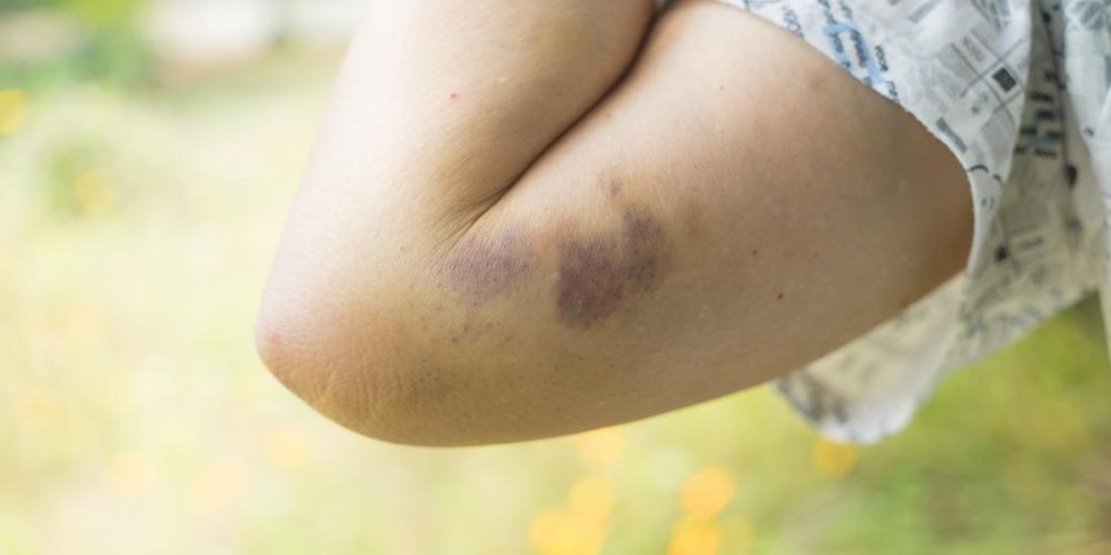 What to know about contusions