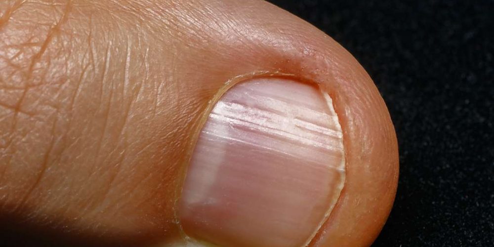 What to know about not having a half-moon on the nails