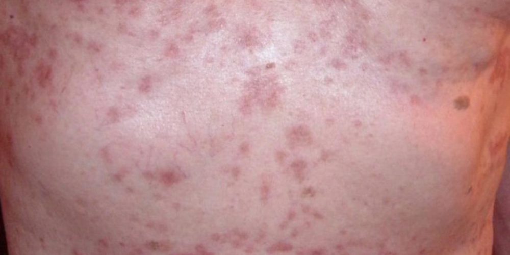What to know about papular eczema