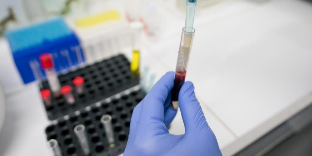 Alzheimer&#8217;s blood test almost &#8216;usable in routine clinical care&#8217;