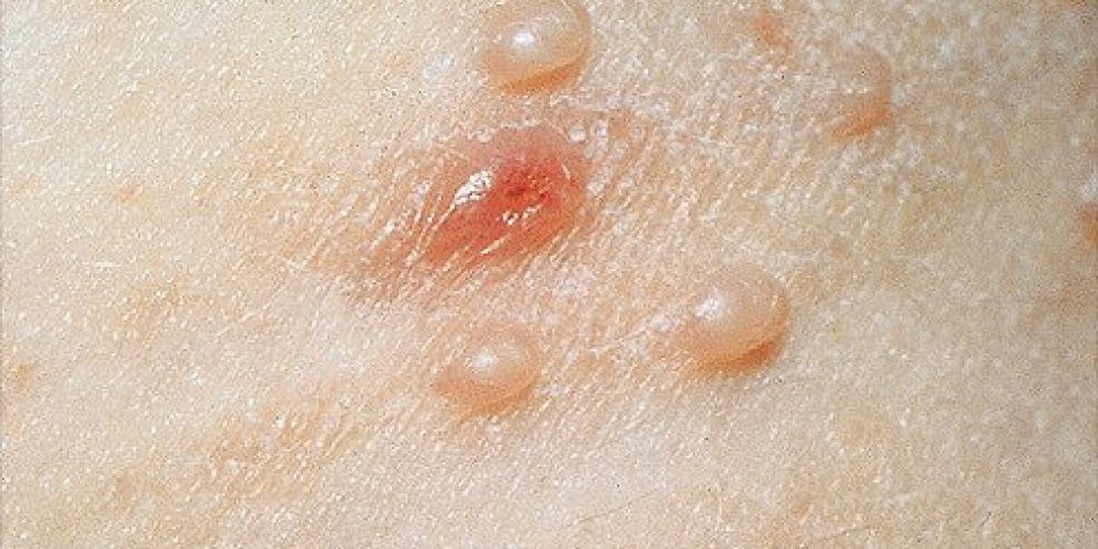Are Skin Rashes Contagious?