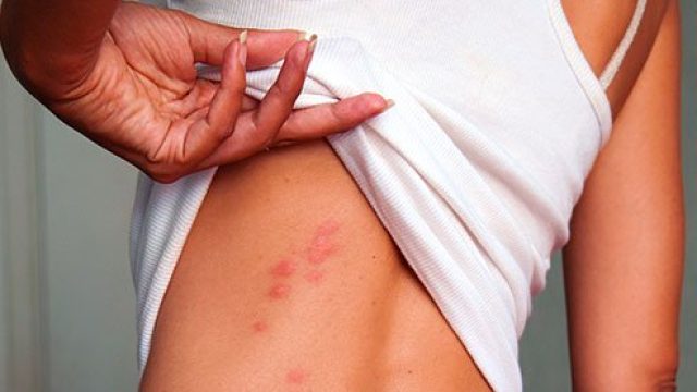 Bedbugs (Bed Bugs) vs. Lice