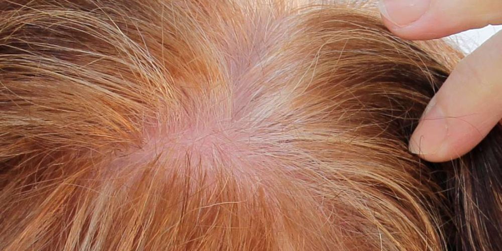 Can PRP treat hair loss?