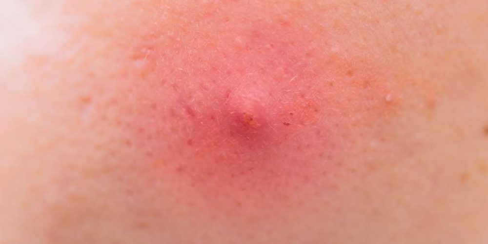 Causes and treatment of pimples in the armpit