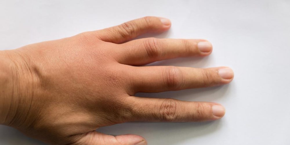 Causes of swollen hands