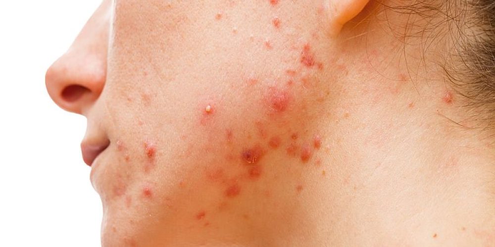 Curbing a Skin Oil Might Help Curb Acne, Study Suggests