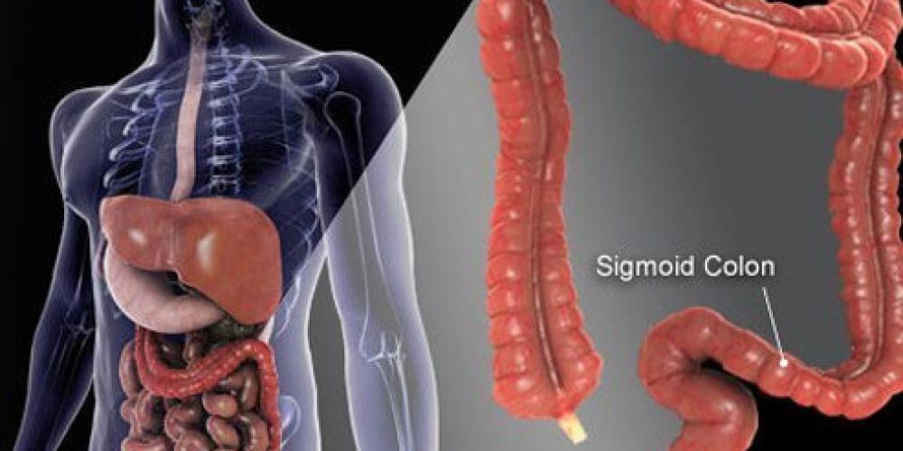 Early Warning Signs and Stages of Colon Cancer