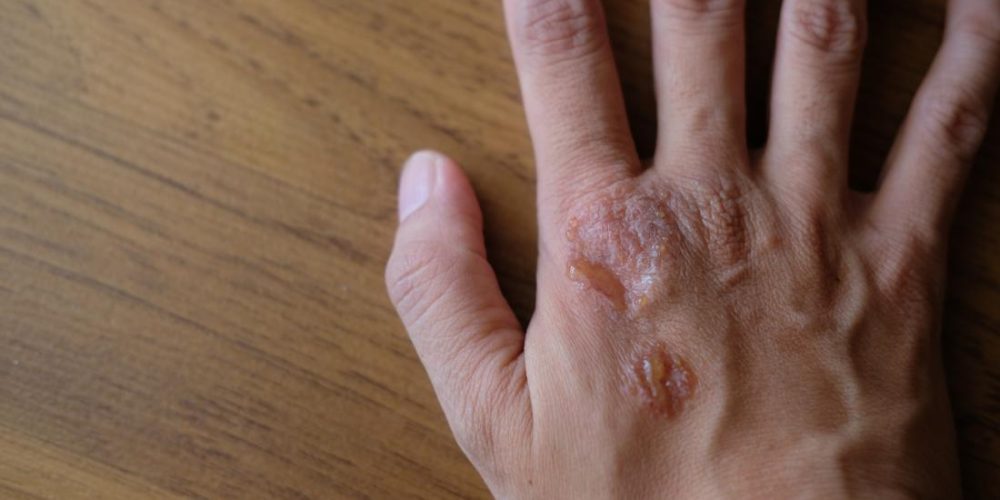 How are psoriasis and HIV related?