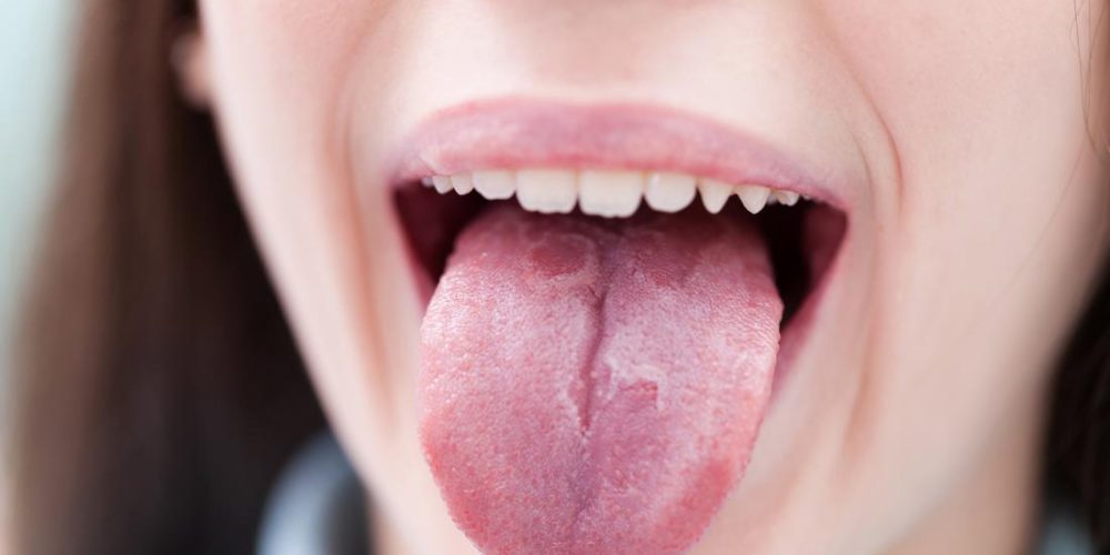 How can psoriasis affect the mouth and tongue?