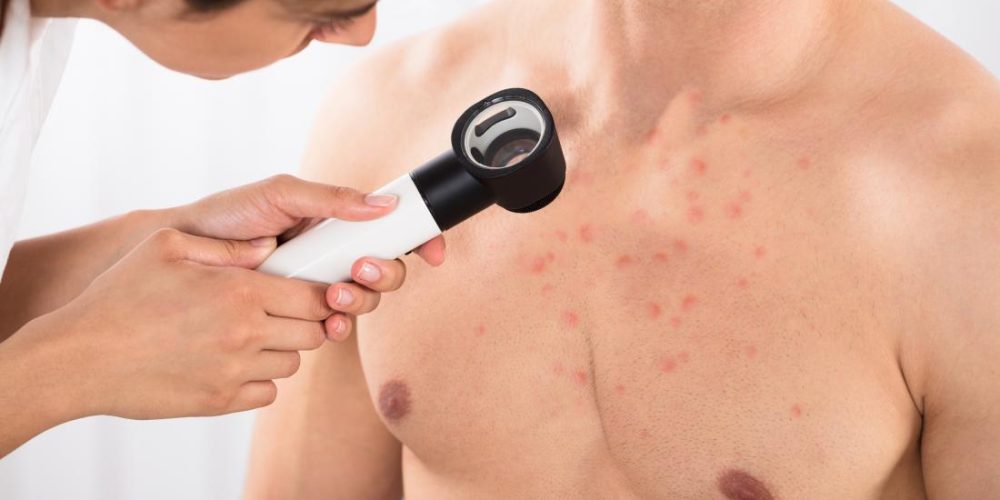 How do you get rid of chest acne?