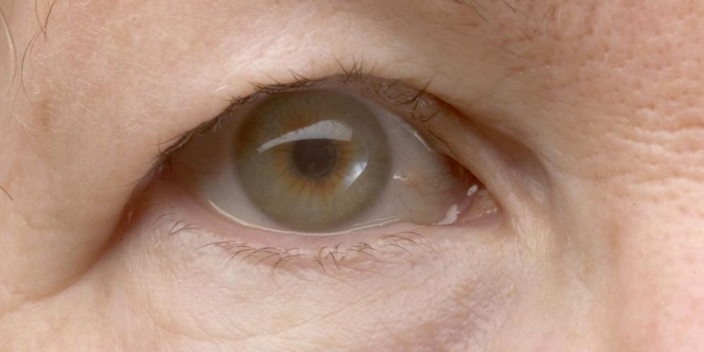 How do you treat a droopy eyelid?
