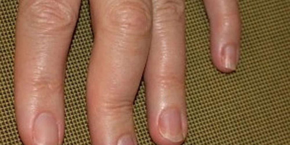 How does psoriatic arthritis affect the hands?