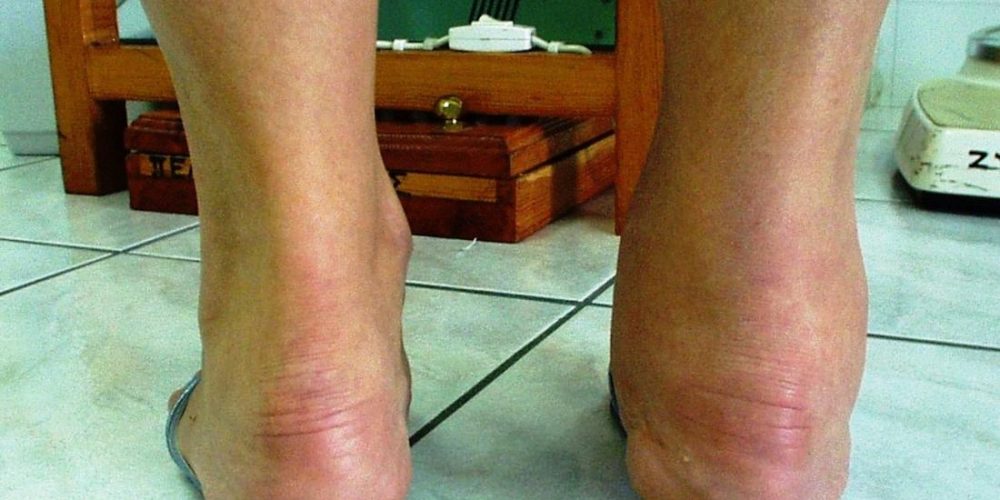 How does rheumatoid arthritis affect the ankles?