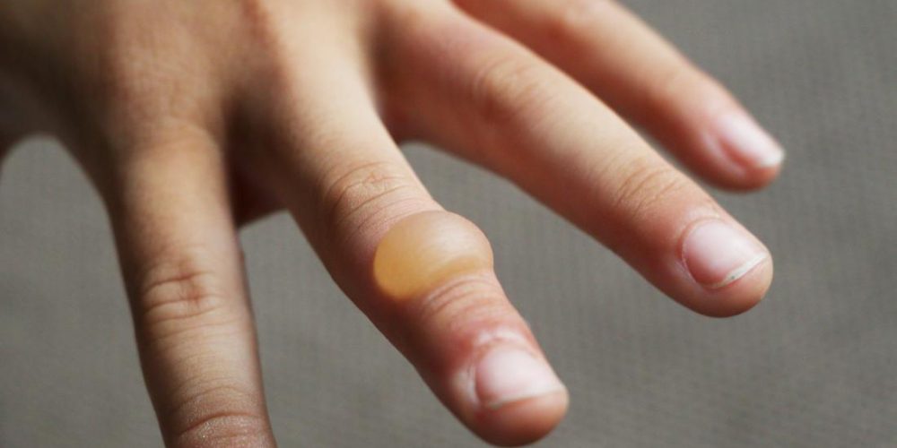 How to recognize and treat a burn blister