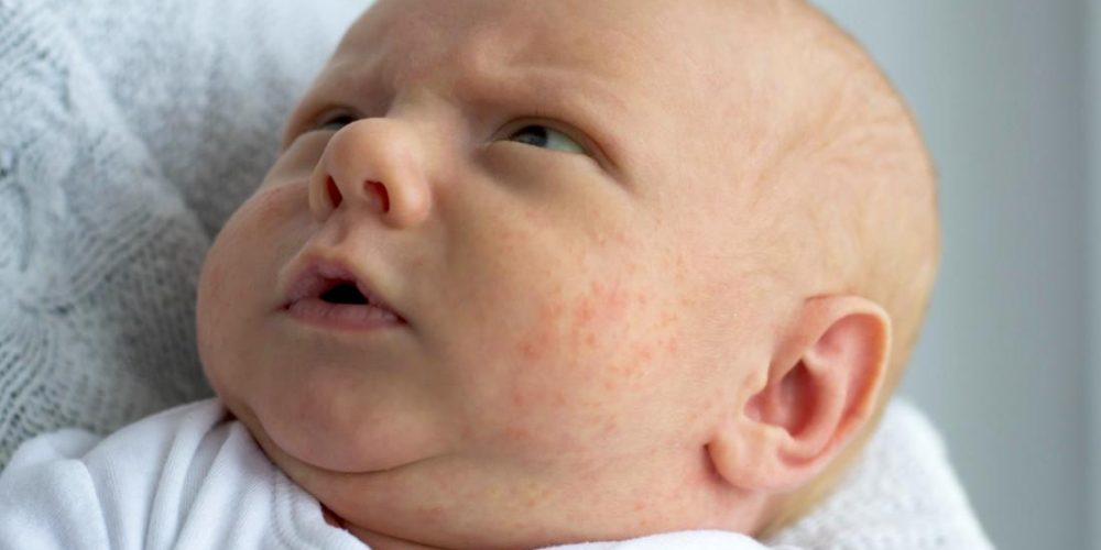 Is this rash baby acne or eczema?