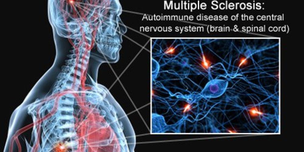 Multiple Sclerosis (MS) Early Warning Signs and Types
