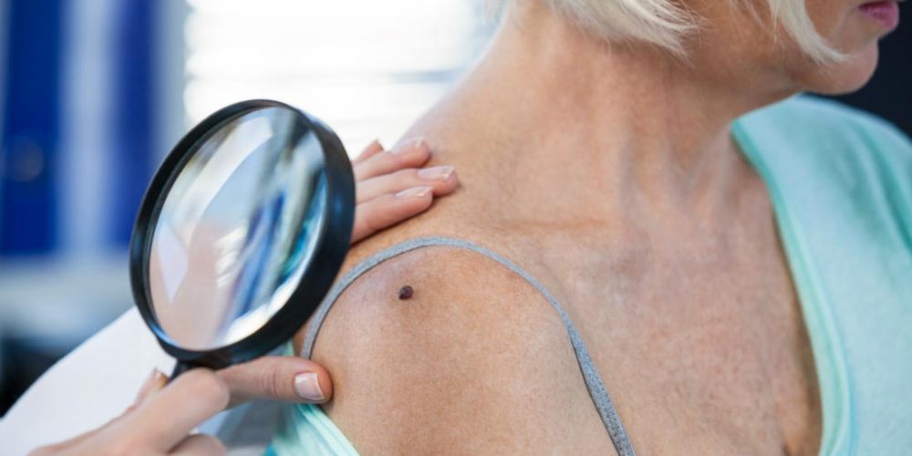 New compound could fight off aggressive melanoma