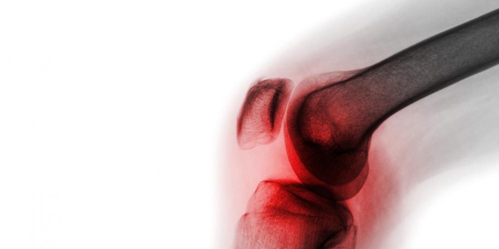 Osteoarthritis: New compound may stop the disease
