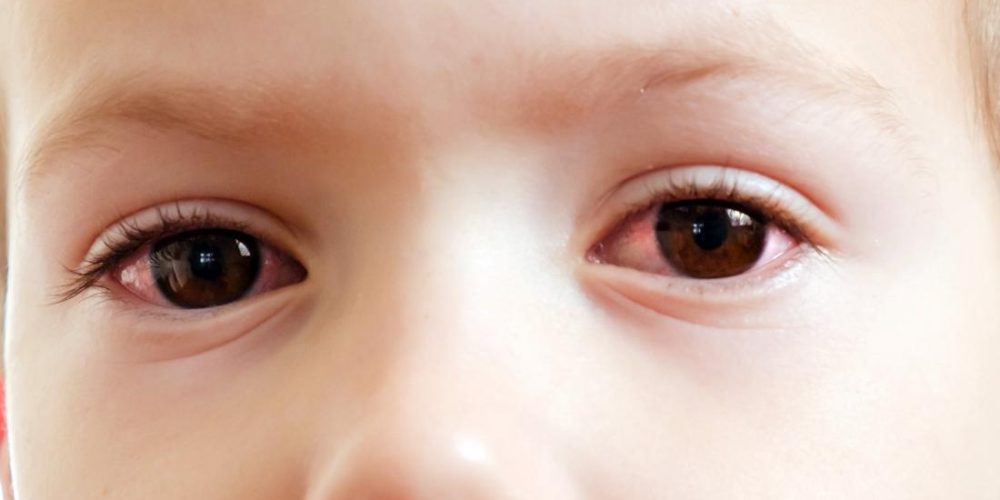 Pink eye in toddlers: Everything you need to know