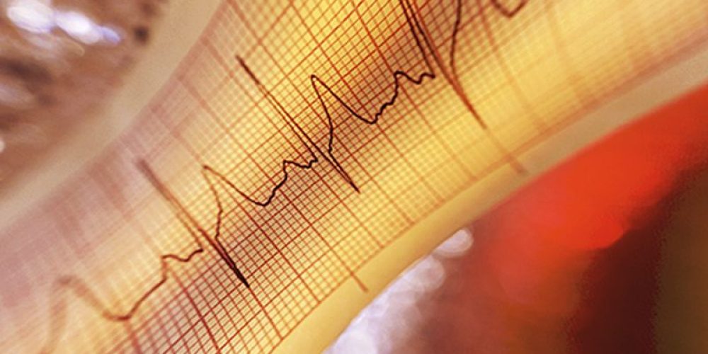 Radiation Rx Might Ease a Dangerous Irregular Heart Beat