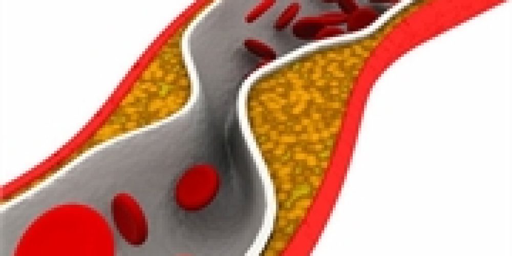 Study Casts Doubt on Angioplasty, Bypass for Many Heart Patients