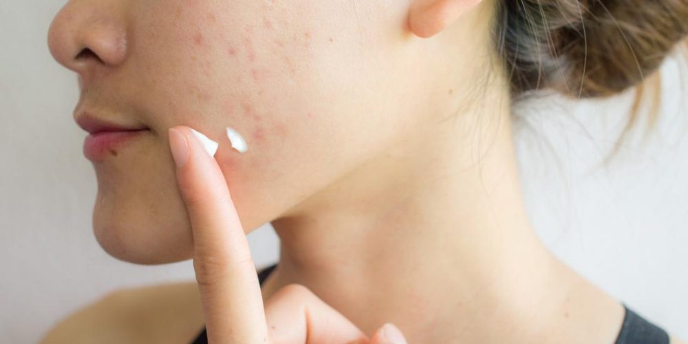 The best ways to get rid of acne scars
