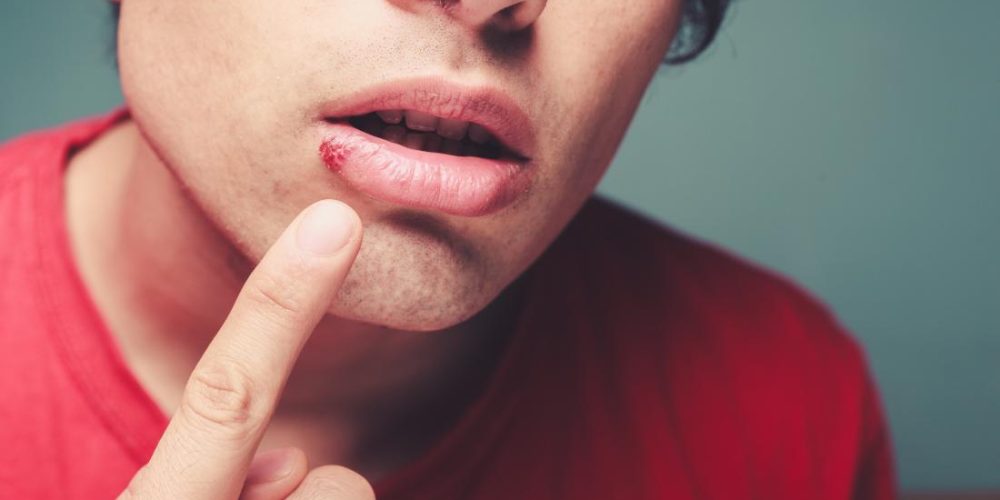 Todo lo que necesita saber sobre los herpes labiales