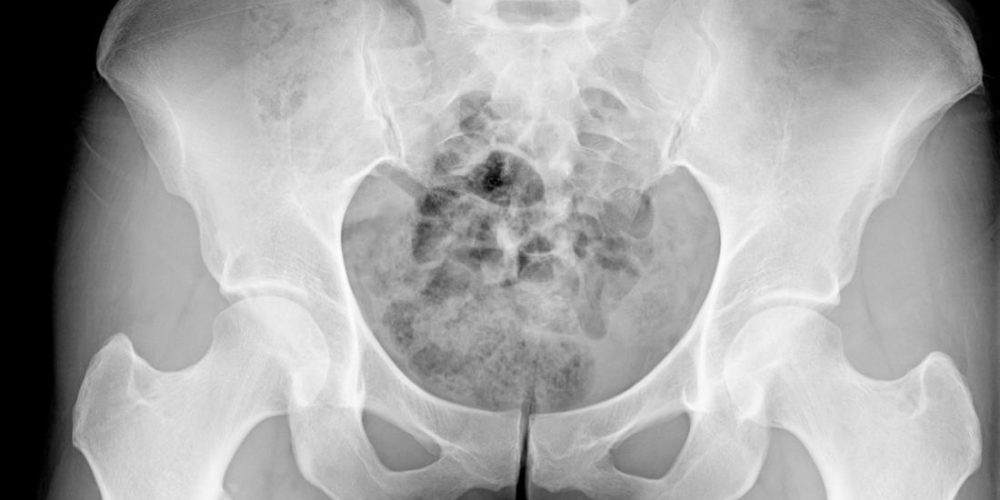 Vitamins B-6 and B-12 linked with increased risk of hip fracture