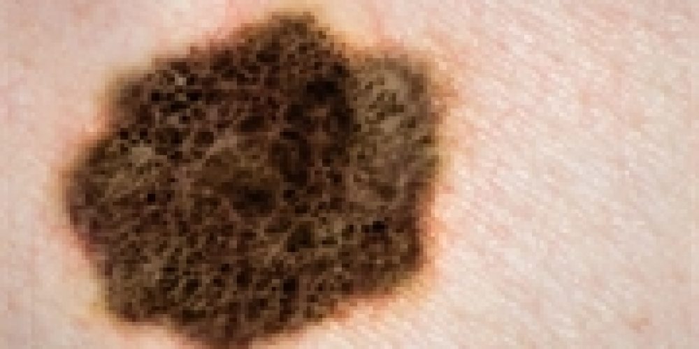 Weight-Loss Surgery Might Also Lower Skin Cancer Risk