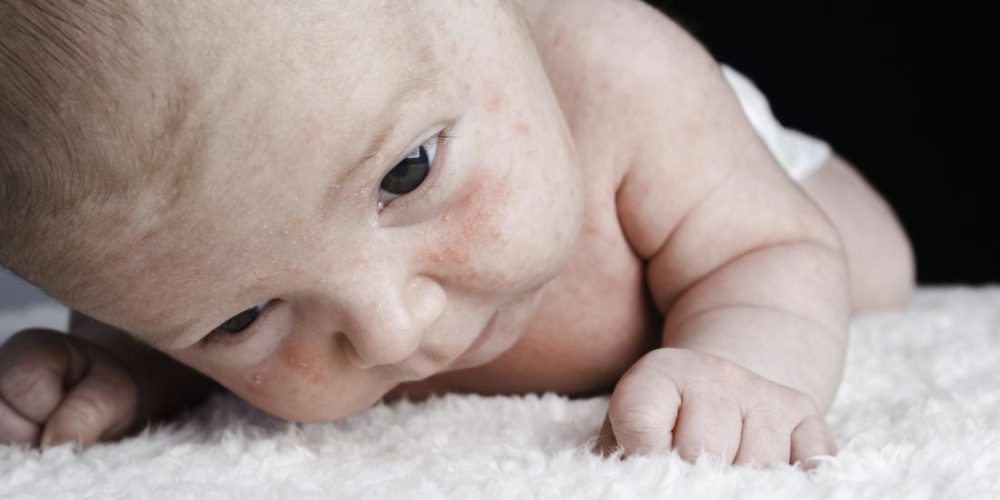 What causes dry skin on a baby&#8217;s face?