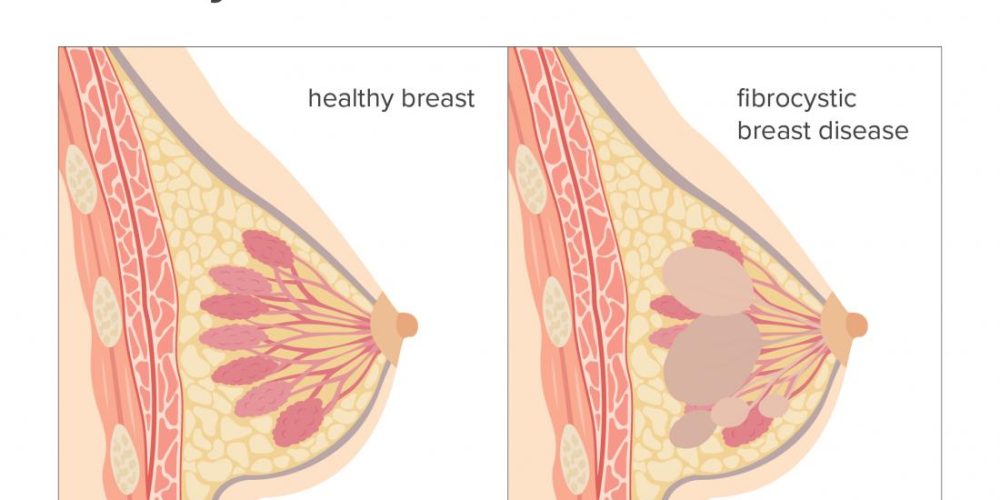 What is fibrocystic breast disease?