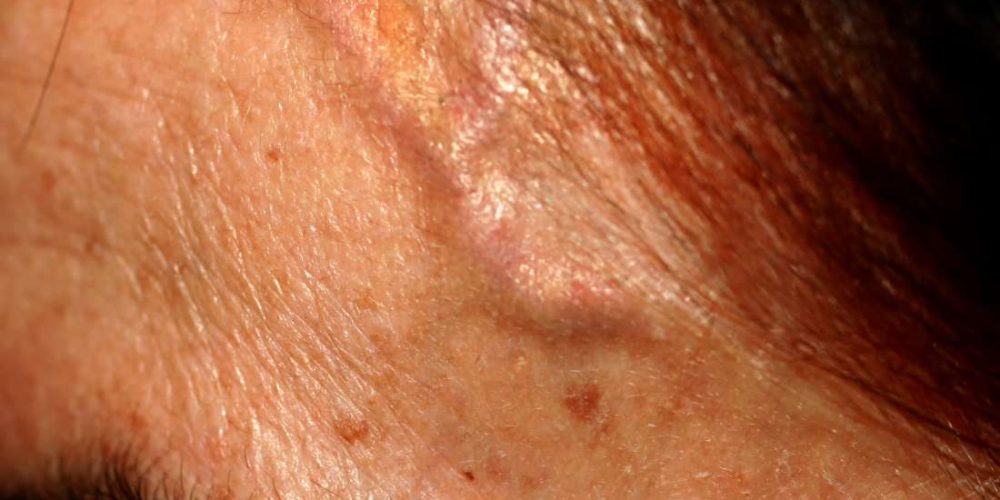What to know about forehead veins