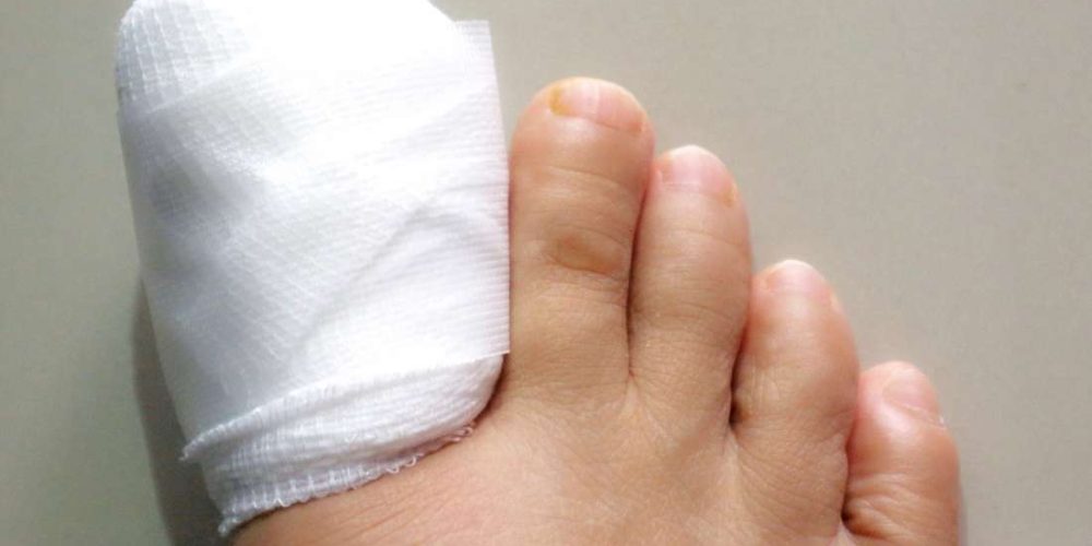 What to know about ingrown toenail surgery