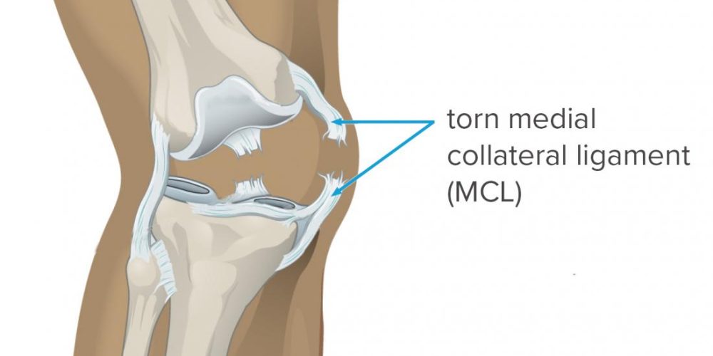 What to know about MCL tears