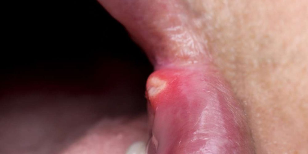 What to know about mouth sores from chemo