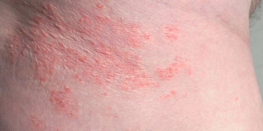 What&#8217;s the difference between inverse psoriasis and intertrigo?
