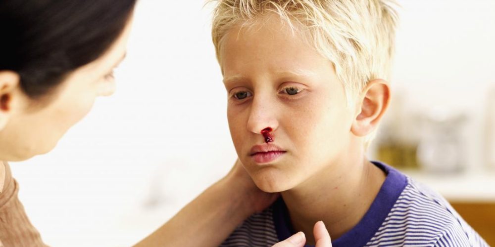 When to see a doctor if a child has a nosebleed