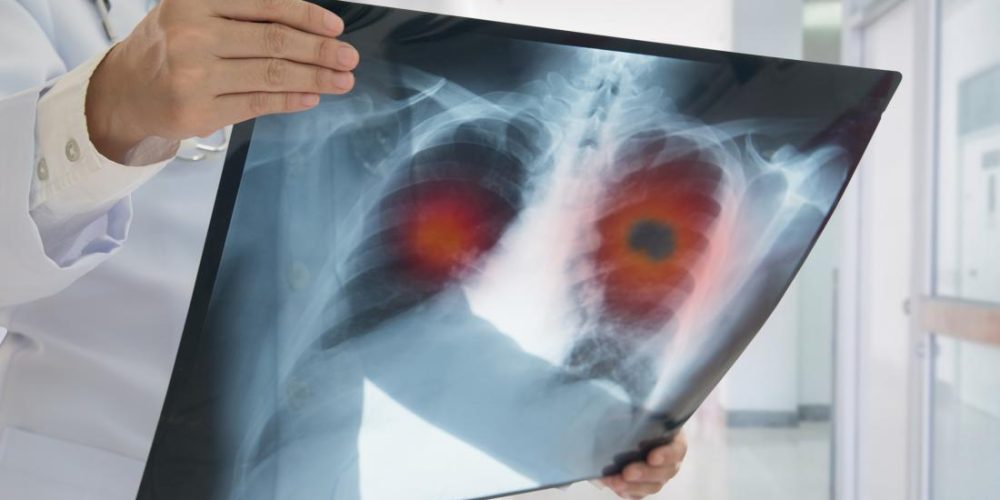 Why is lung cancer so difficult to treat?
