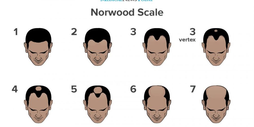 What to know about the Norwood scale and male pattern baldness