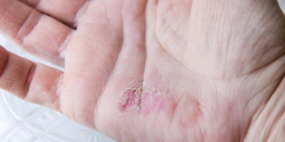 What to know about winter rash